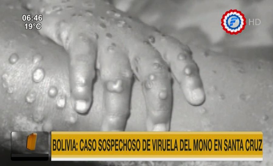 Detectan caso sospechoso de viruela del mono en bolivia