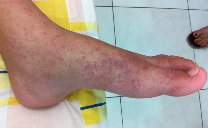 Salud denuncia a naturalista de CDE por dar remedio contra chikungunya