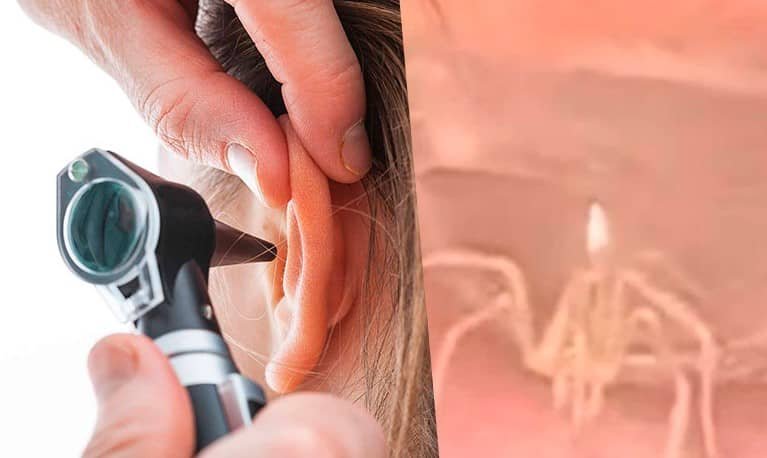 Encuentran araña viviendo en el oído de una paciente