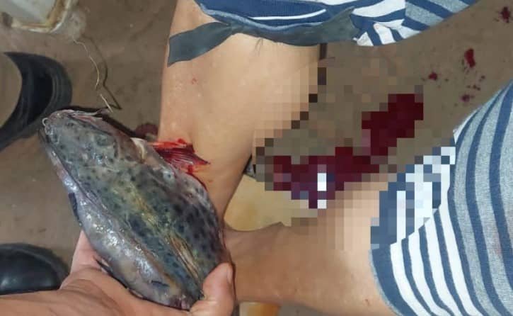 Insólito Accidente un pescado se incrusta en la pierna de una mujer