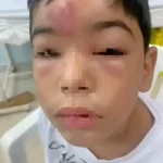 Niño hospitalizado tras ser picado por Araña Venenosa
